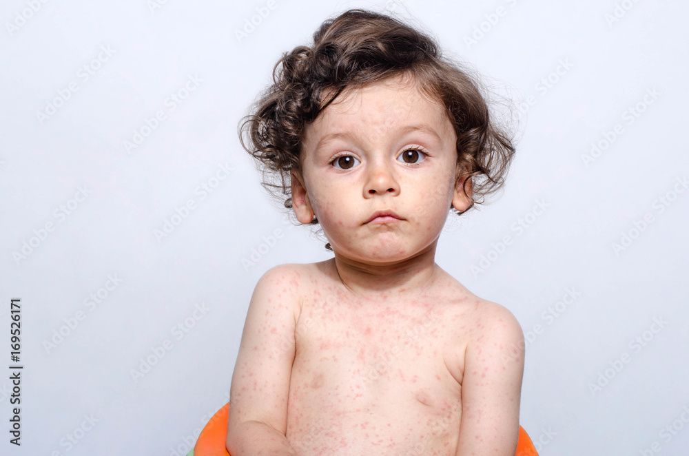 Child with measles
